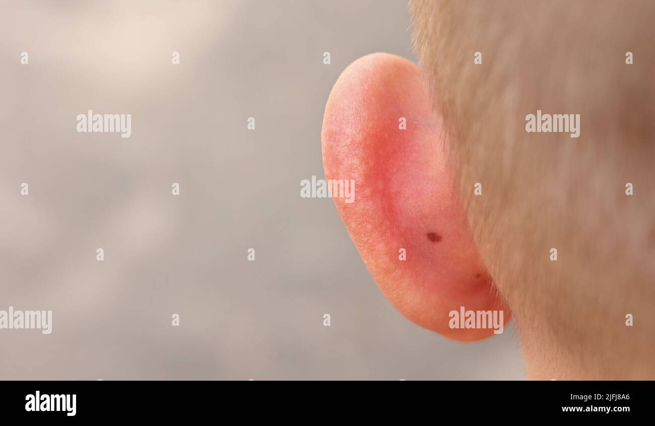 skin sunburnt of child ears from sun close up. back view. summer hot vacation. health and medical concept. Stock Photo