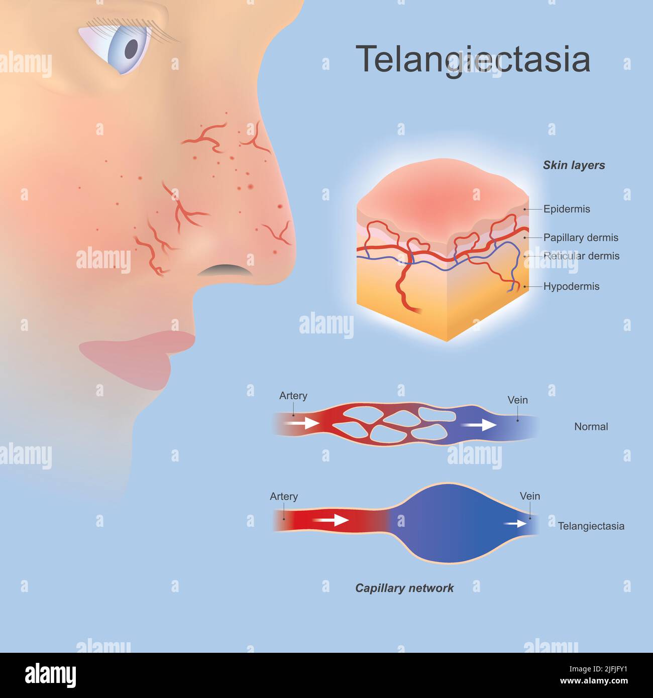 Telangiectasia. Problem tiny blood vessels widened or formed located near surface skin layers and you can clearly see. Stock Vector