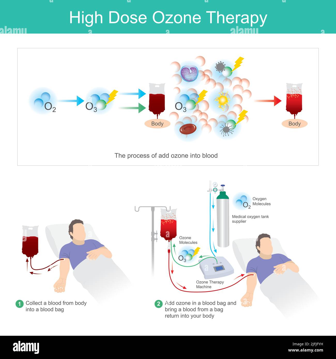 High Dose Ozone Therapy. This process add ozone in a blood bag and bring a blood from a bag return into your body. Stock Vector