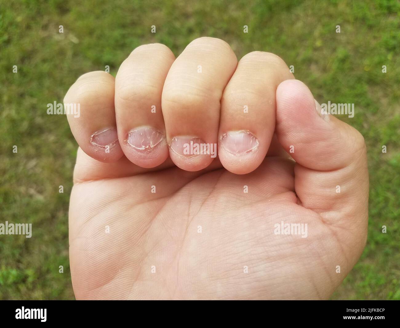 disgusting bitten and chewed fingernails on man's hand. Stock Photo