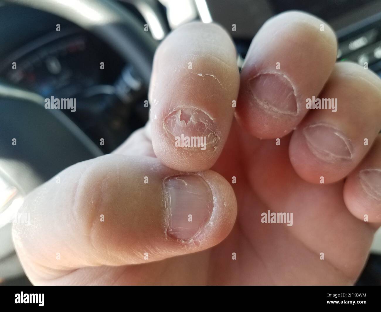 Fingernail damage hi-res stock photography and images - Alamy