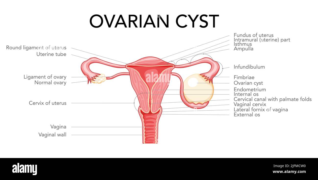 Ovarian cyst diagram Female reproductive system uterus labeled in ...