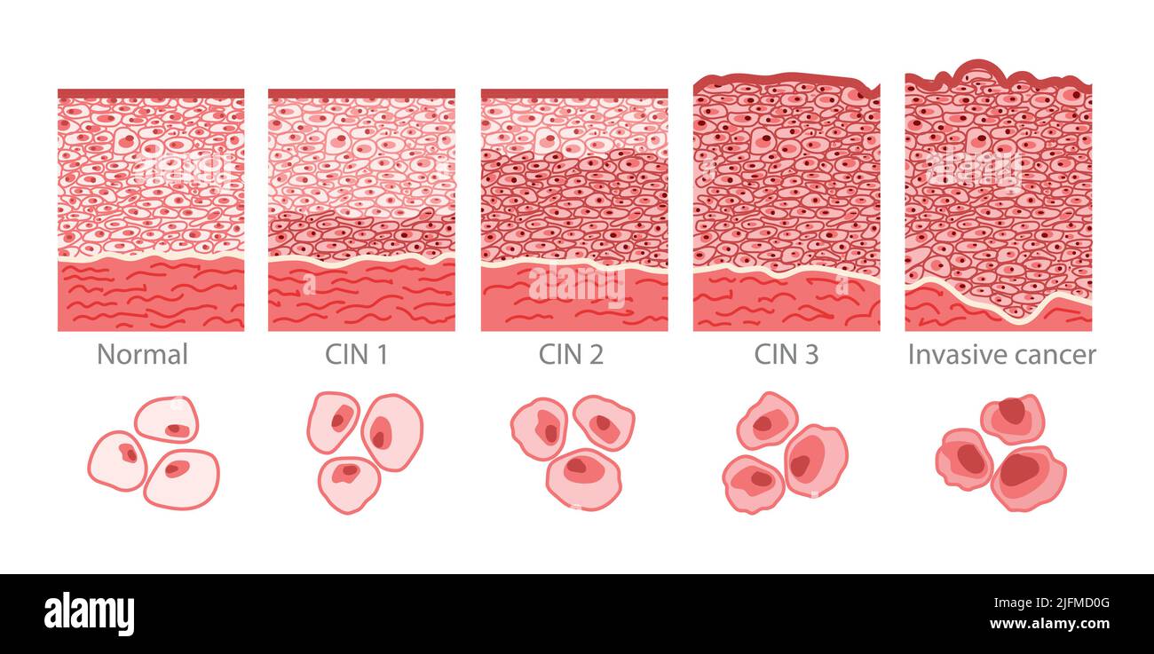 Cervical cancer cells elongated Dysplasia stages infographic Female ...