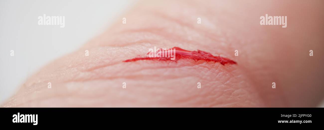 Injured persons finger with bleeding open cut wound Stock Photo