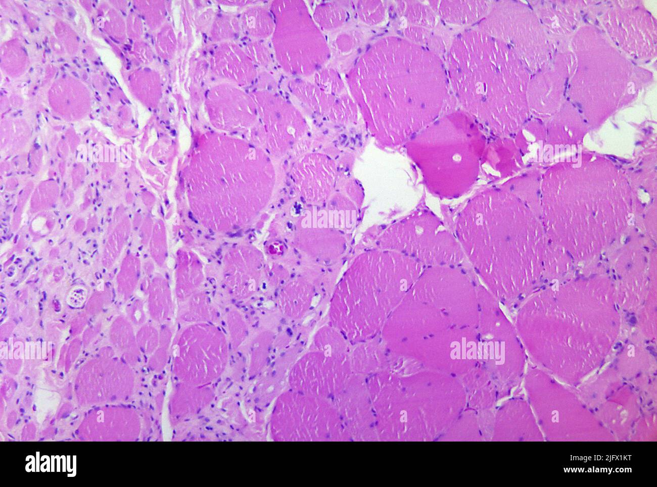 A photomicrograph of skeletal muscle tissue revealing myotonic dystrophic changes as a result of Polio Type III. When spinal neurons themselves die, Wallerian degeneration takes place resulting in muscle weakness of those muscles once innervated by the now dead neurons (denervated). The degree of paralysis is directly correlated to the number of deceased neurons.   An optimised and enhanced version of an image produced by the US Centers for Disease Control and Prevention / credit CDC /Dr.Karp Stock Photo
