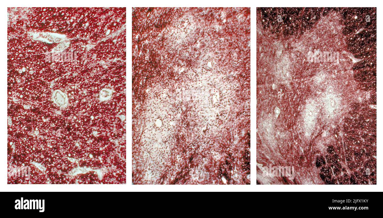 Three photomicrographs of the cervical spinal cord in the region of the anterior horn revealing Polio Type III degenerative changes. The poliovirus has an affinity for the anterior horn motor neurons of the cervical and lumbar regions of the spinal cord. Death of these cells causes muscle weakness of those muscles once innervated by the now dead neurons. Digitally colourised /false  colour image.  Optimised and enhanced versions of images produced by the US Centers for Disease Control and Prevention / credit CDC /Dr.Karp Stock Photo