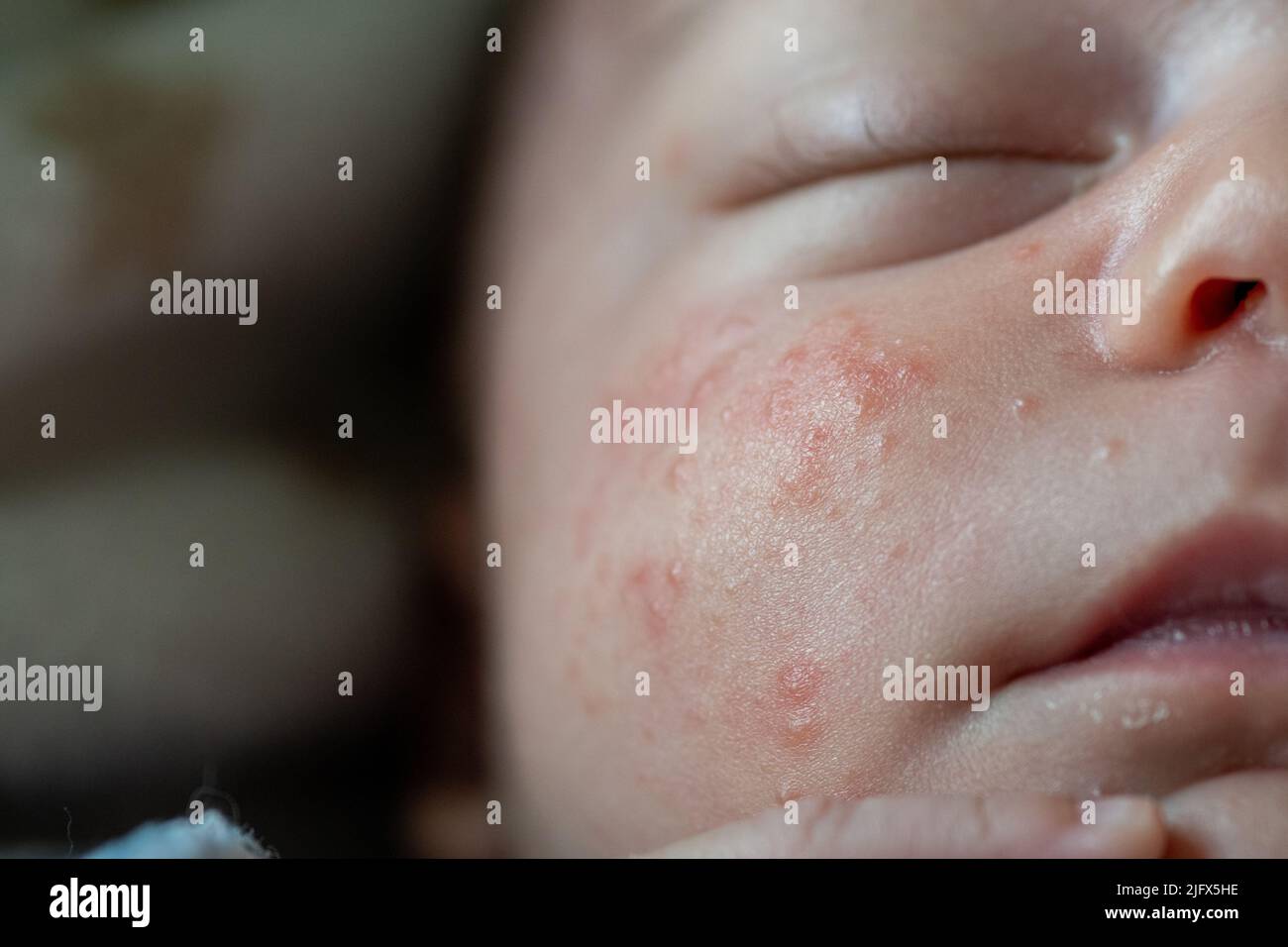 baby face baby with milia acne, engordaderas, keratin accumulations