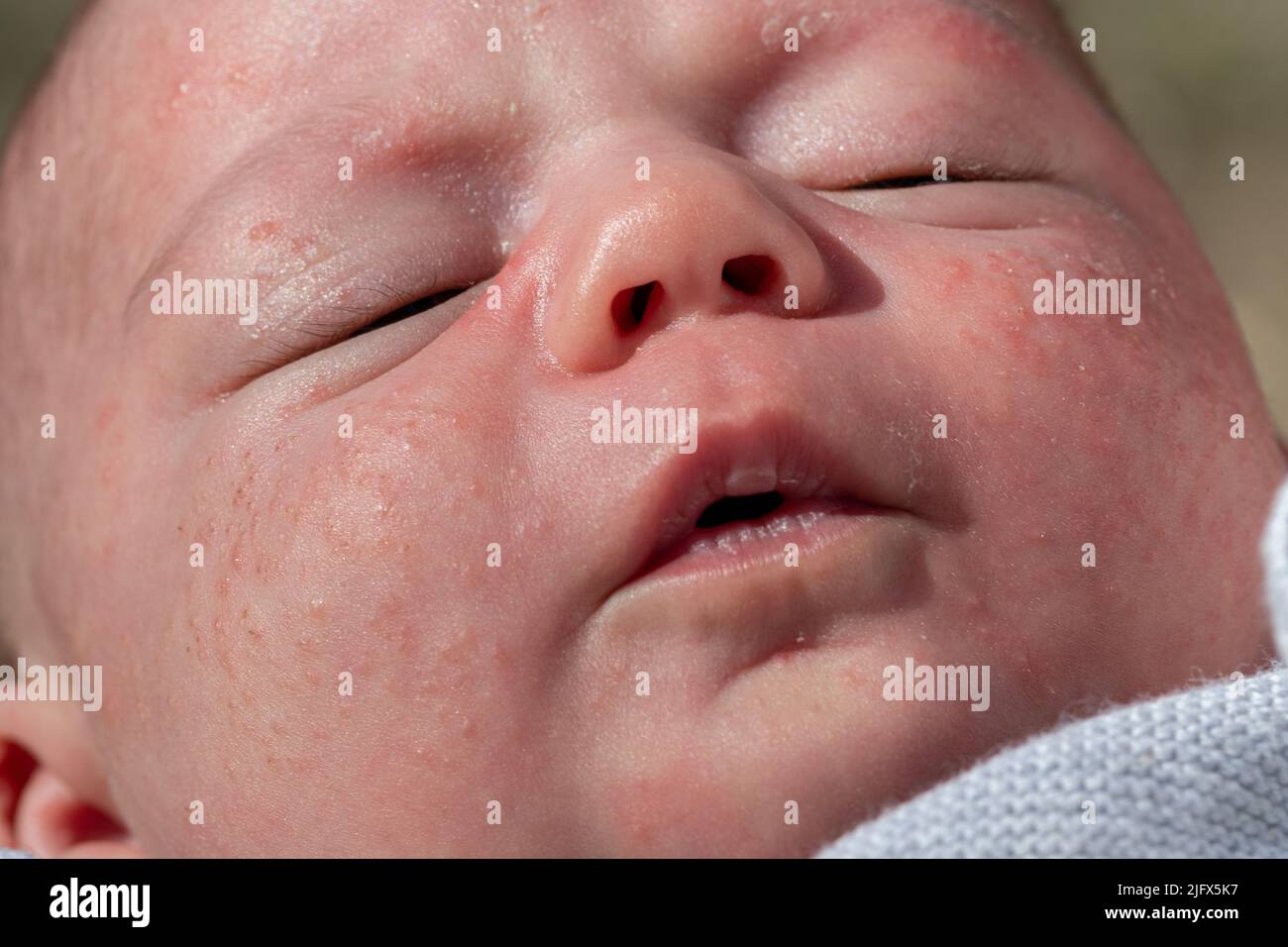 baby face baby with milia acne, engordaderas, keratin accumulations