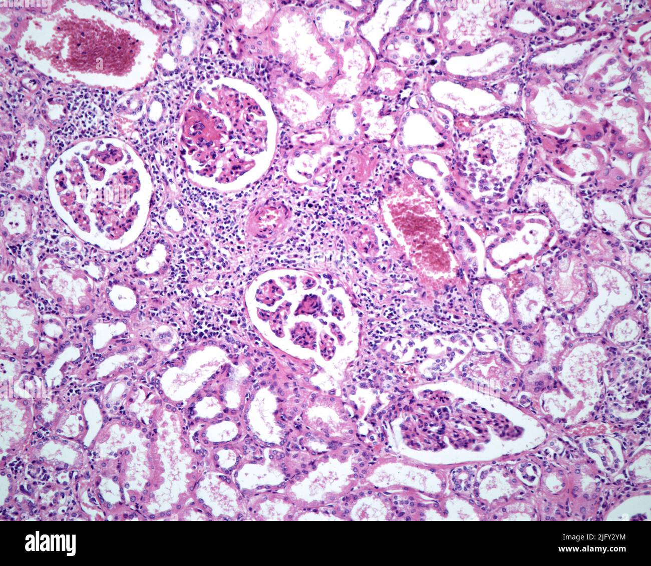 Polyarteritis nodosa, light micrograph Stock Photo - Alamy