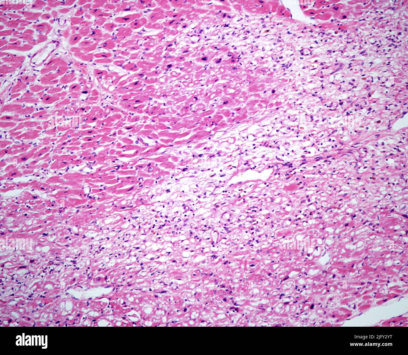 Acute myocardial infarction, light micrograph Stock Photo - Alamy