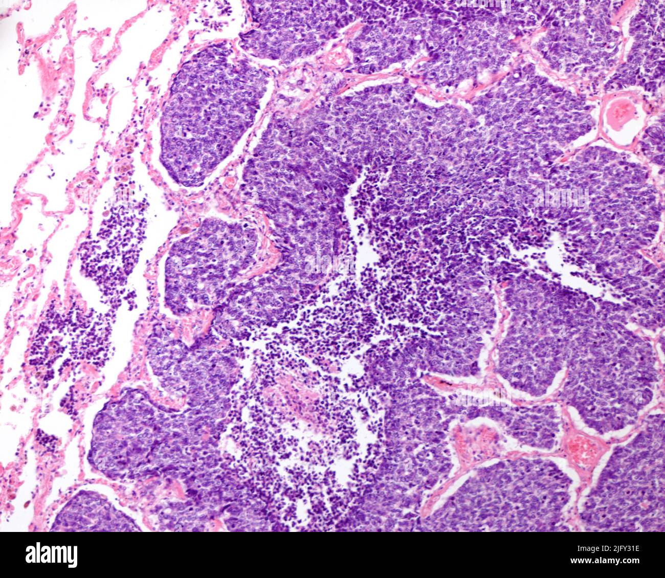Small cell lung carcinoma, light micrograph Stock Photo - Alamy