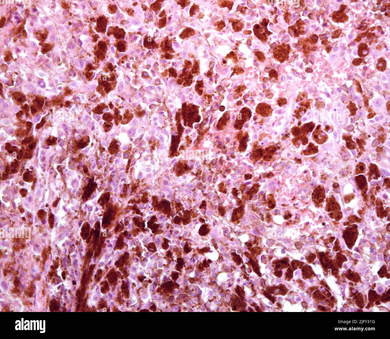 Metastasis of malignant melanoma, light micrograph Stock Photo - Alamy