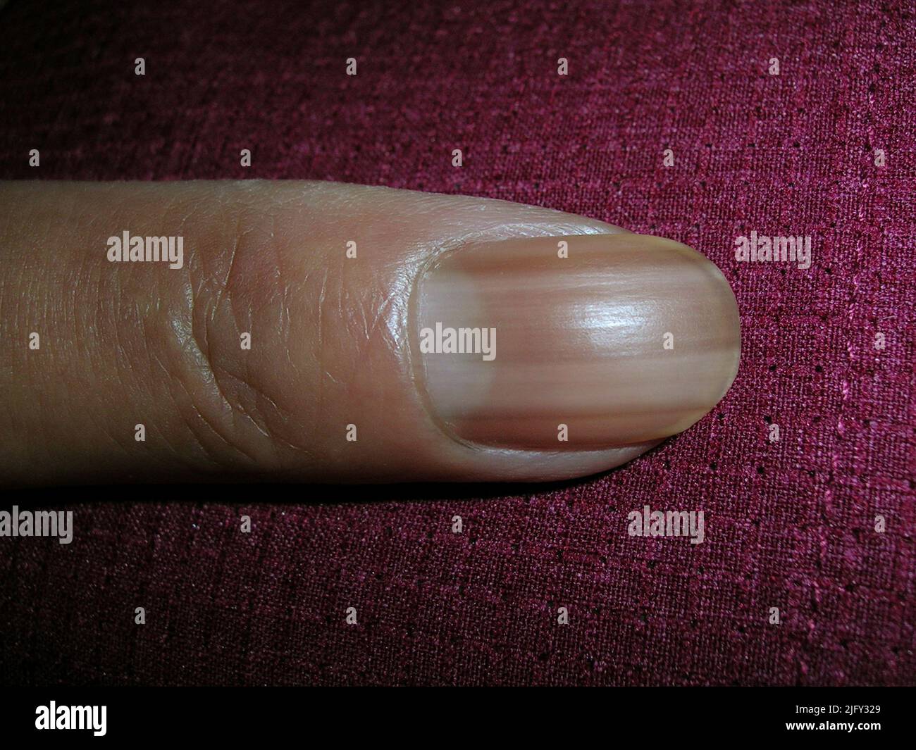 Discoloured nail Stock Photo