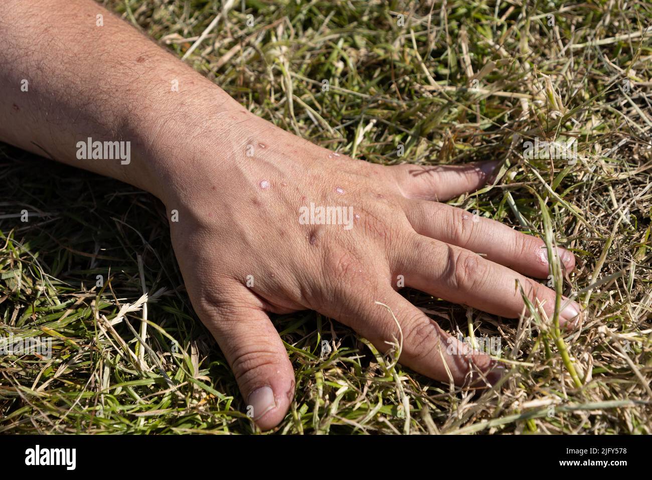 Mild case of Psoriasis or eczema on hands Stock Photo
