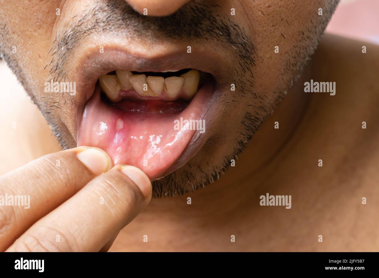 Mouth ulcer hi-res stock photography and images - Alamy, image size:1300x956