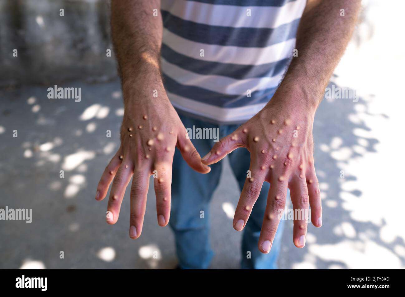 hands affected by smallpox. Man with blisters on his hands from monkeypox. Stock Photo