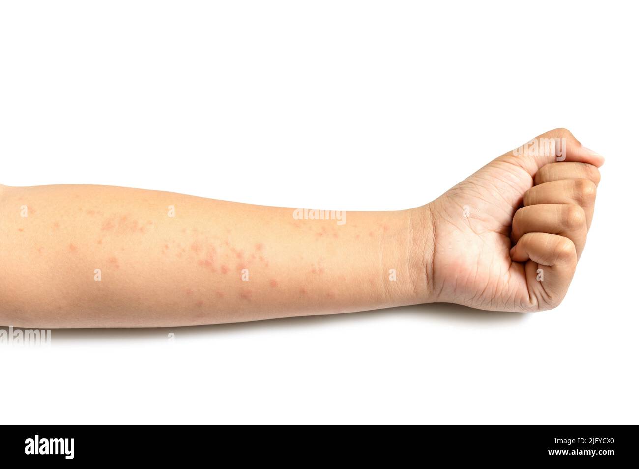 People getting red rash on the arm skin isolated on white background. Skin care concept Stock Photo