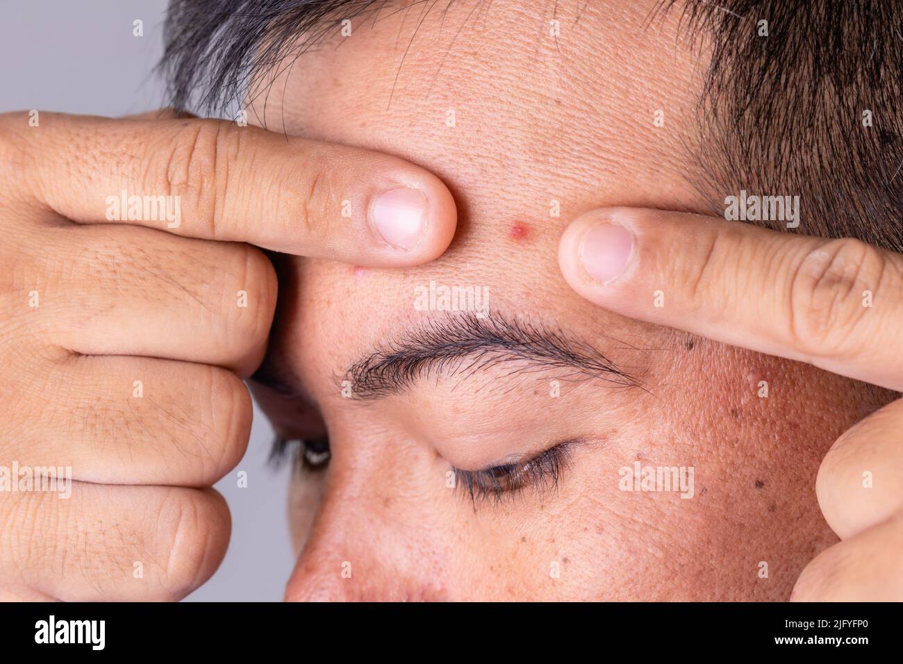 Macro face skin of asian man to show many skin problem. Men skin care concept on grey space background Stock Photo