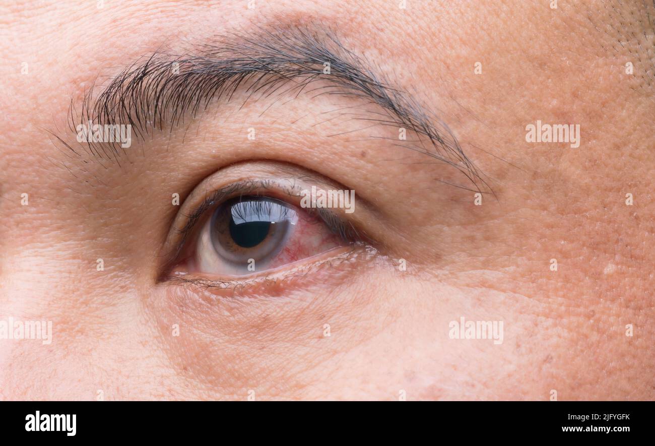 Eye irritation concept Macro red eye of man, conjunctivitis eye or