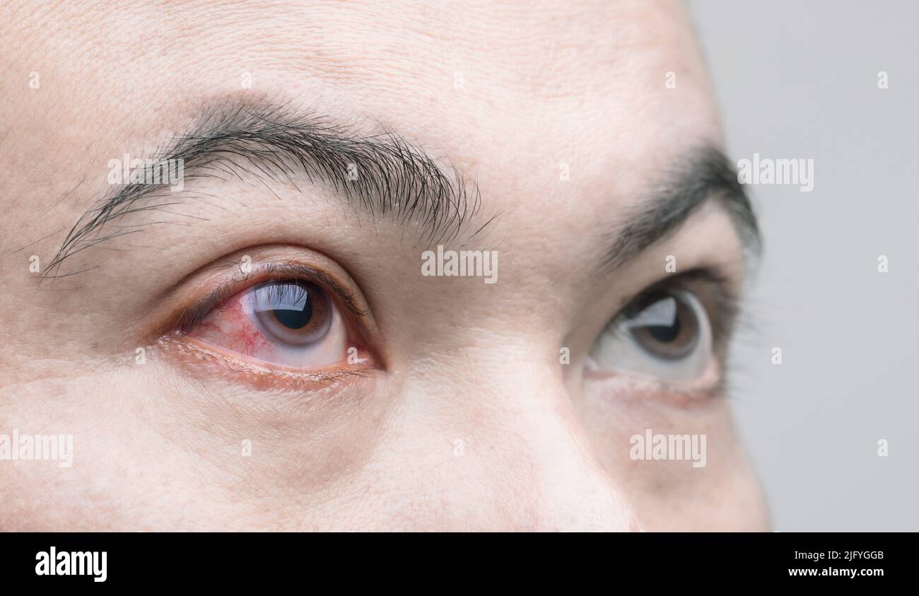 Eye irritation concept Macro red eye of man, conjunctivitis eye or