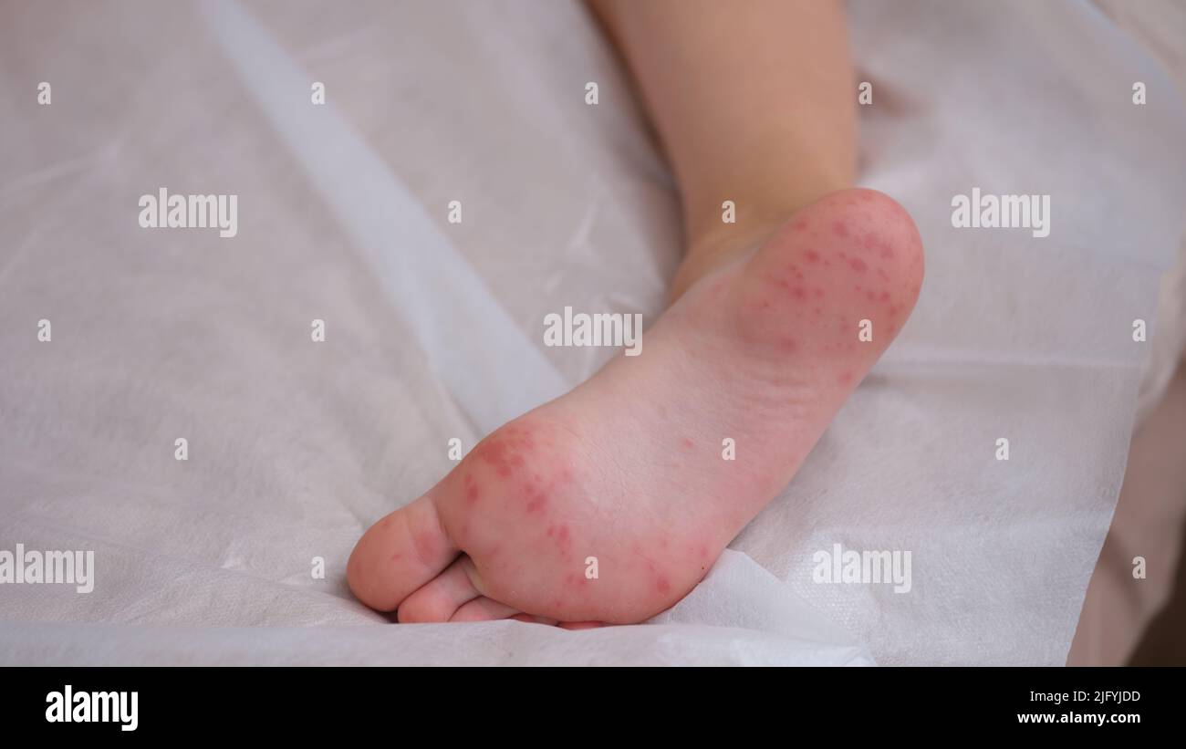 Child foot with red itchy rash closeup Stock Photo Alamy