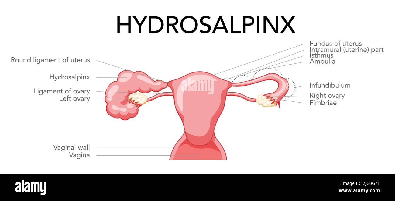 Set of Hydrosalpinx Female reproductive system blocked fallopian tube uterus with description text. Human anatomy internal organs vector medical illustration flat style isolated on white background Stock Vector
