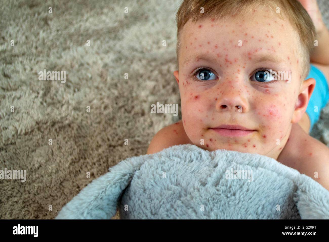 Natural vaccination. Contagious disease Stock Photo Alamy