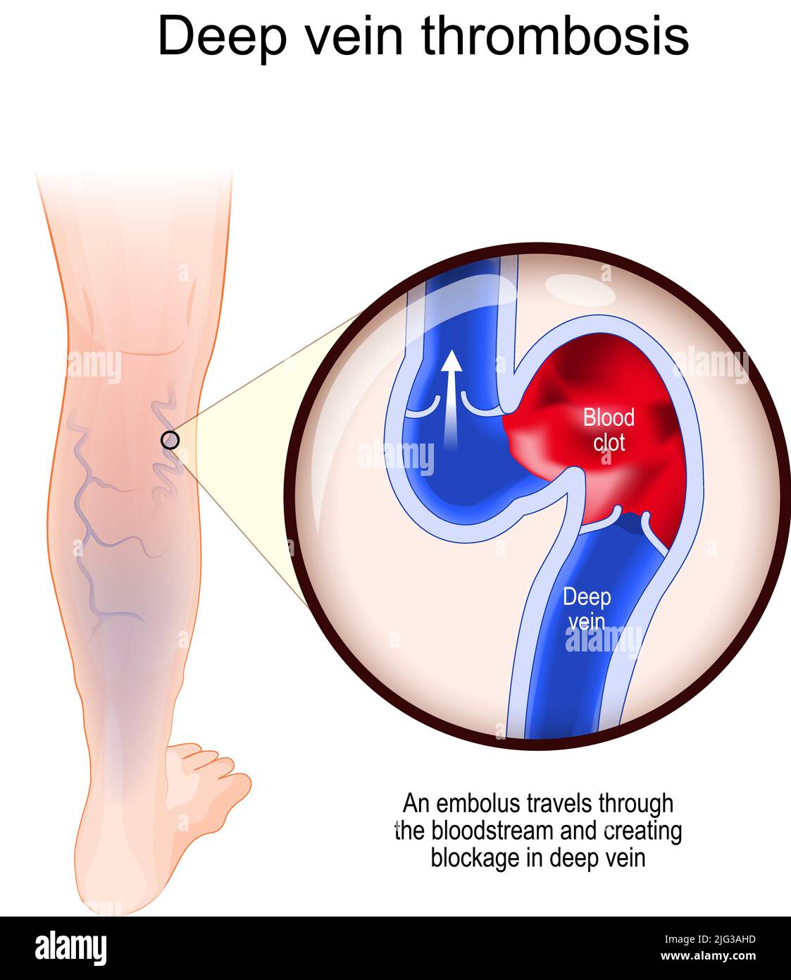 Deep Vein Thrombosis. An embolus travels through the bloodstream. creating block in deep vein. Close-up of blood vessel with blood clot. Cross section Stock Vector