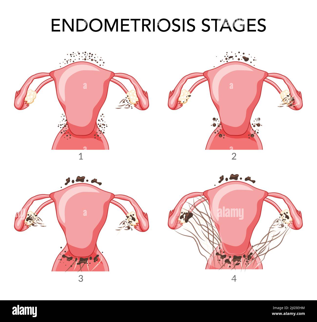 Set of Endometriosis stages Female reproductive system pain pcos tissue