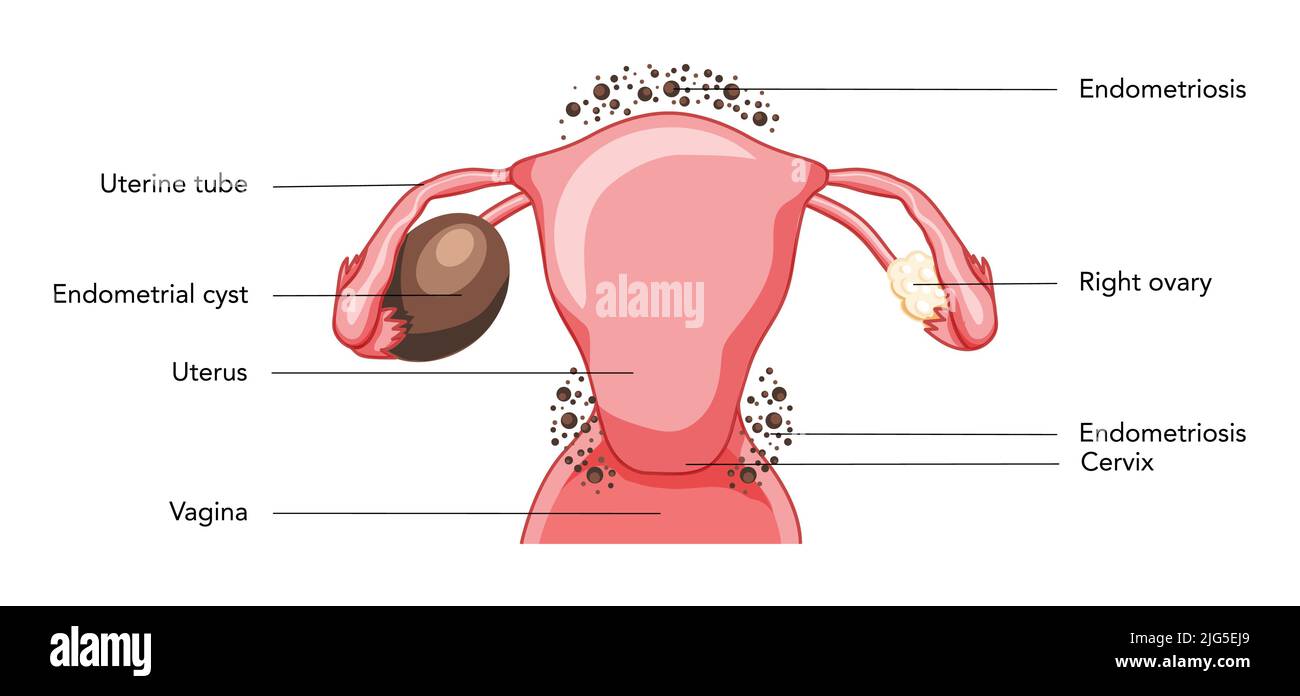 Ovarian endometriomas chocolate cysts Female reproductive system uterus