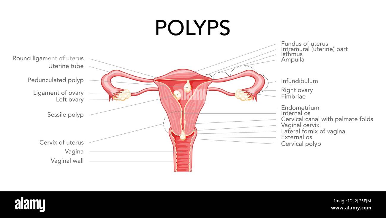 Polyp in the uterus with inscriptions diagram Female reproductive ...