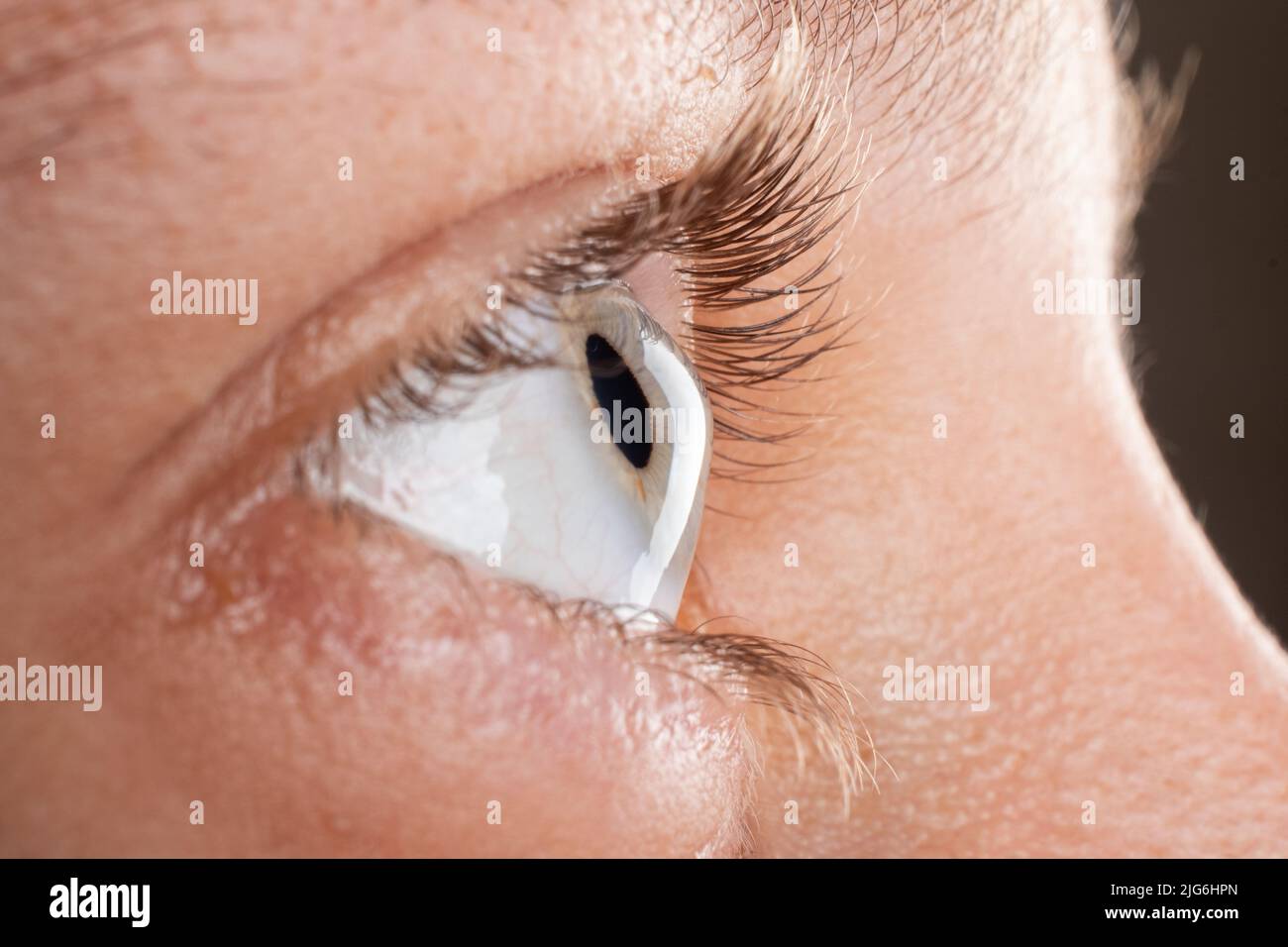 female eye diagnosed with keratoconus corneal thinning. Stock Photo