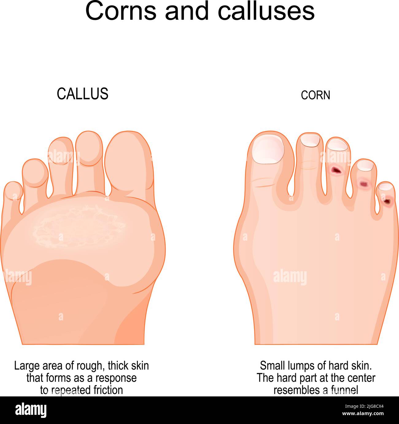 bunions corns calluses