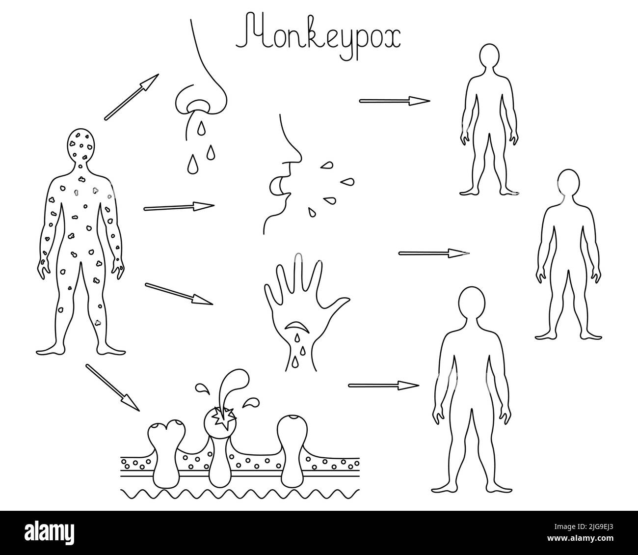 Methods of human infection with monkey pox, transmission of smallpox from person to person Stock Vector