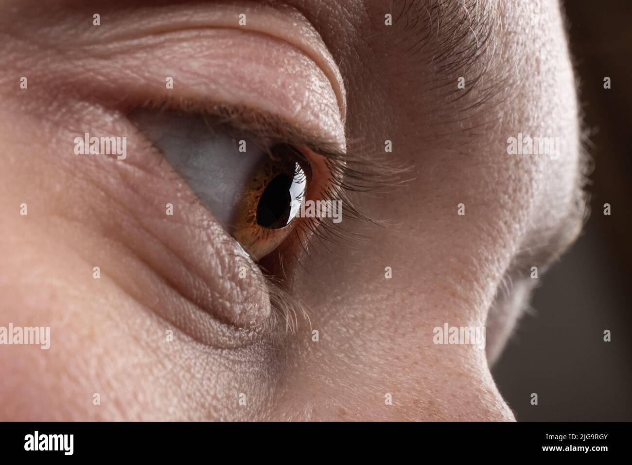 keratoconus disease of the cornea of  the eye macro, fatigue corneal thinning. Stock Photo