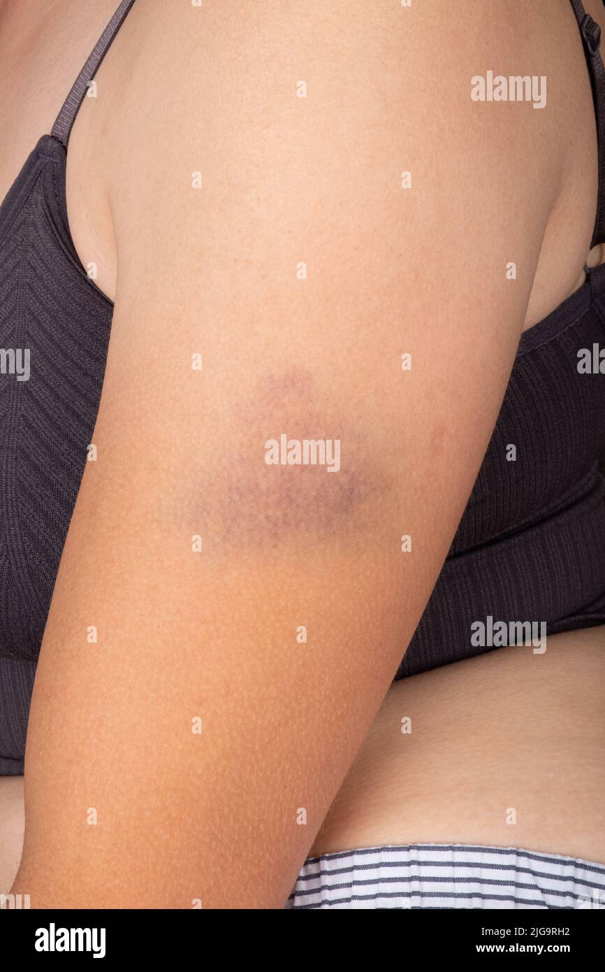 Hematoma on the female butt leg. Woman buttocks bruise. Domestic violence  concept. Young woman with a hematoma on buttocks. Skin bruises on Caucasian  Stock Photo - Alamy