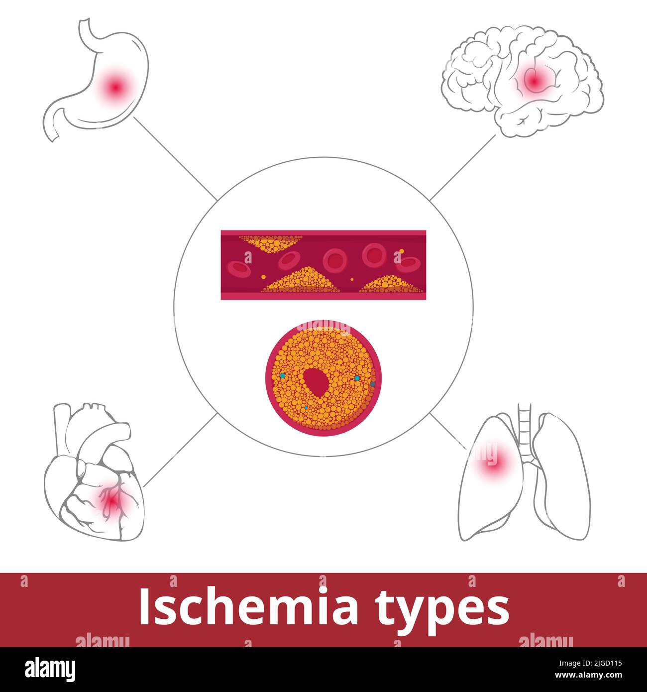Ischemia types. Visualization of restriction in blood supply caused by problems with blood vessels due to vasoconstriction, thrombosis, or embolism. Stock Vector