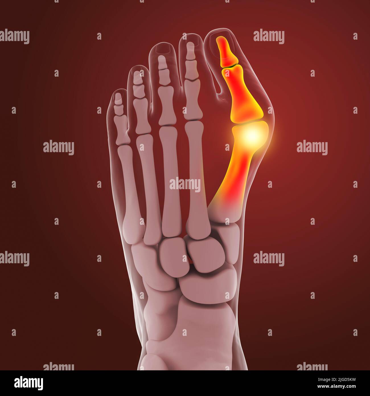 Bunion, illustration Stock Photo