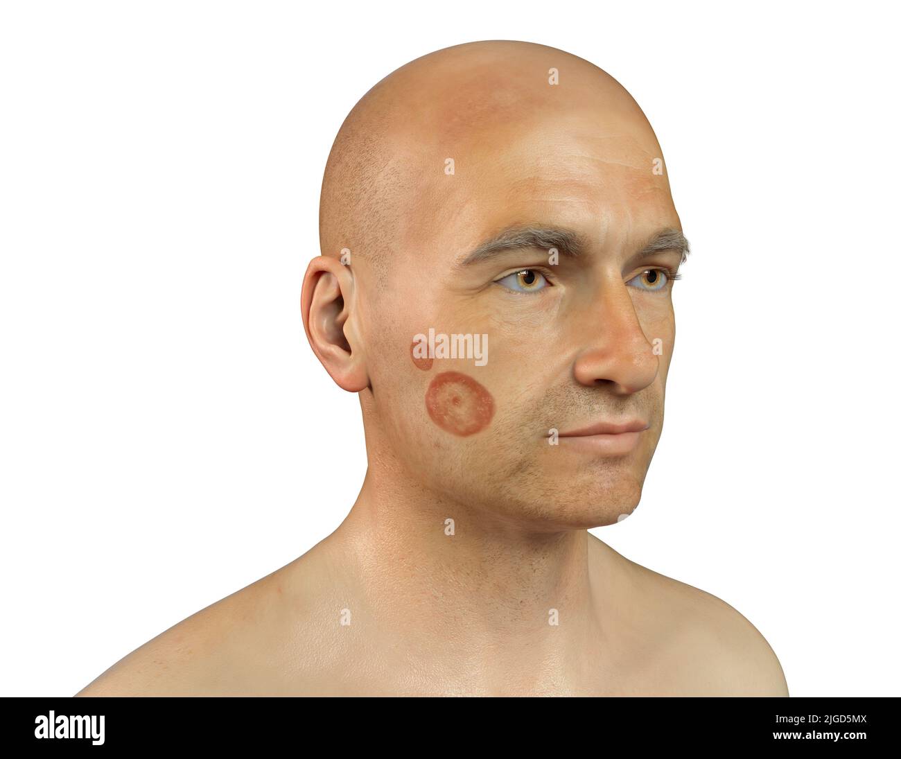 Ringworm, illustration Stock Photo