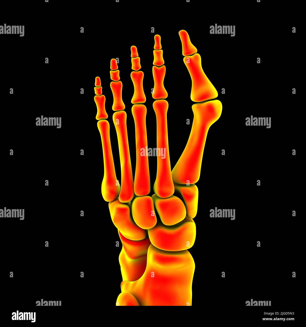 Bunion, illustration Stock Photo