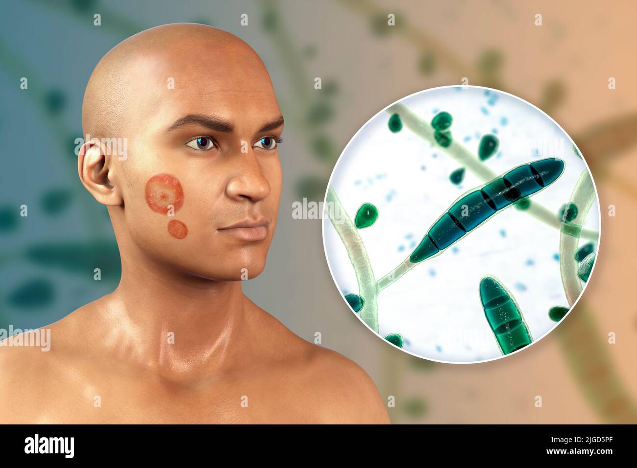 Ringworm, illustration Stock Photo