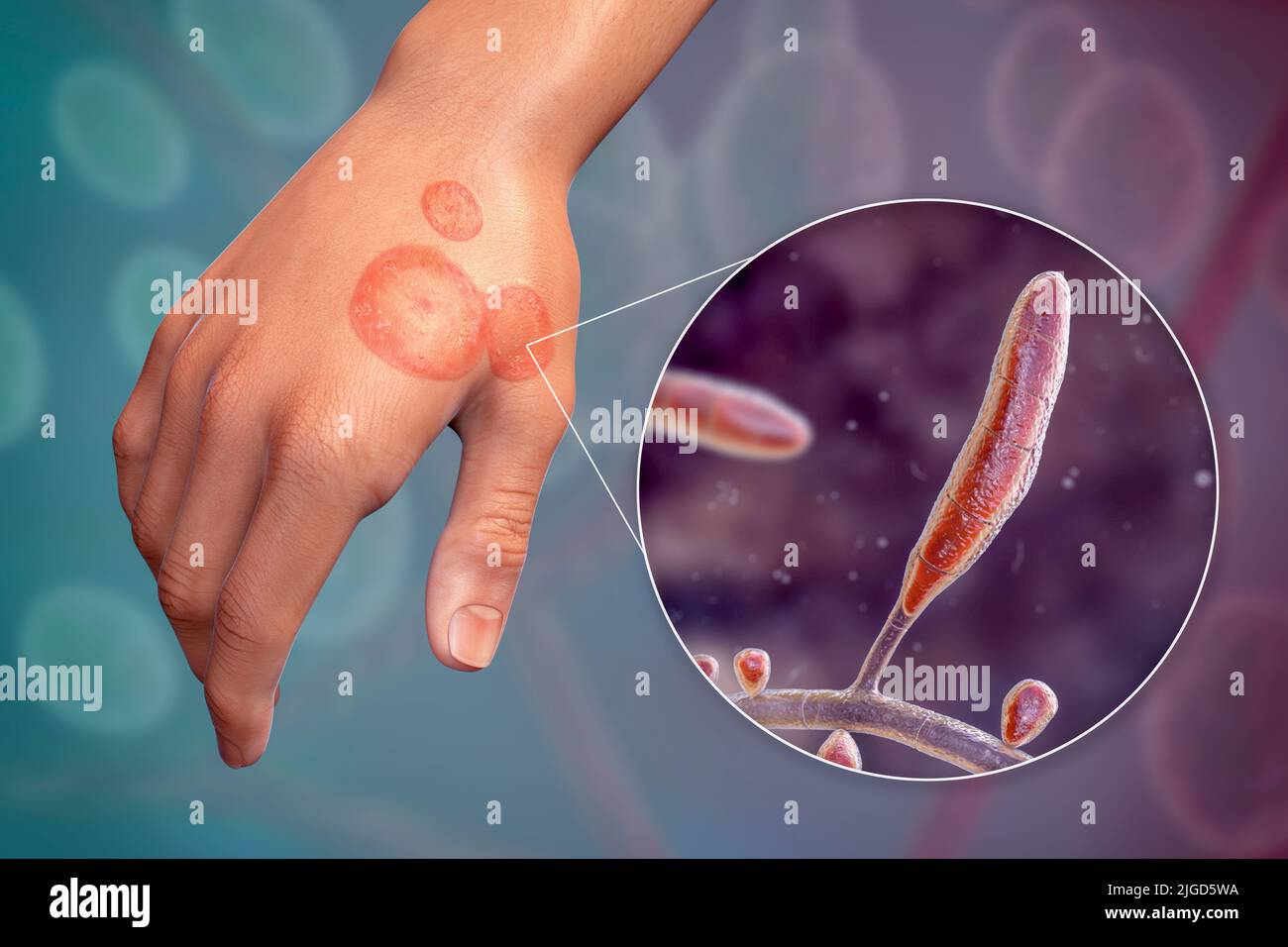 Ringworm, illustration Stock Photo