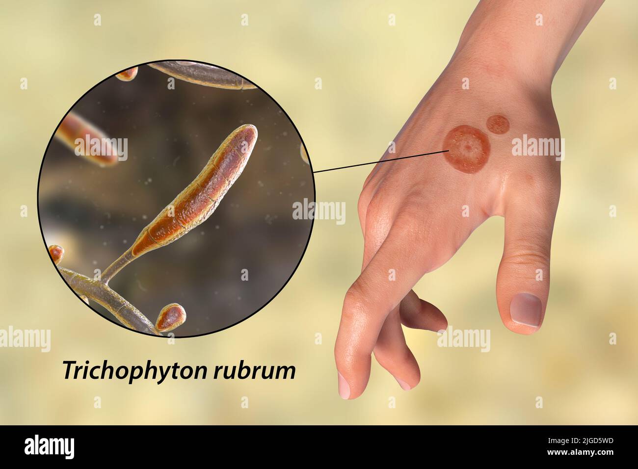 Ringworm, illustration Stock Photo