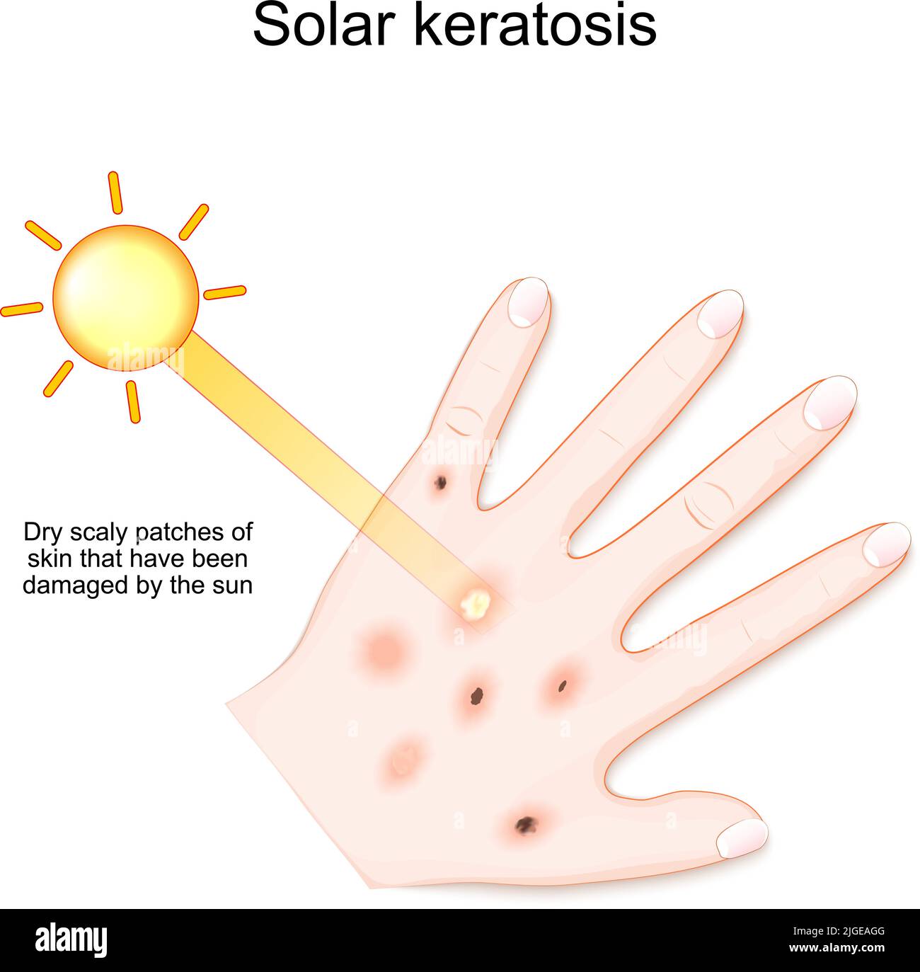 Solar keratosis. Dry scaly patches of skin that have been damaged by the sun. Human's palm with rash after sun. vector illustration Stock Vector