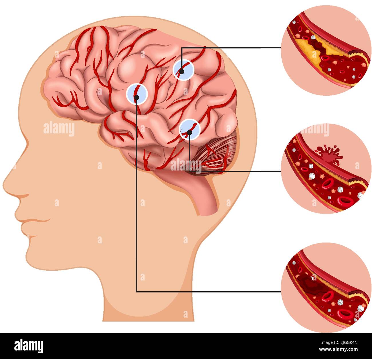 Human With Common Types Of Stroke Infographic Illustration Stock Vector there-are-three-types-of-strokes-hemorrhagic-stroke-ischemic-stroke