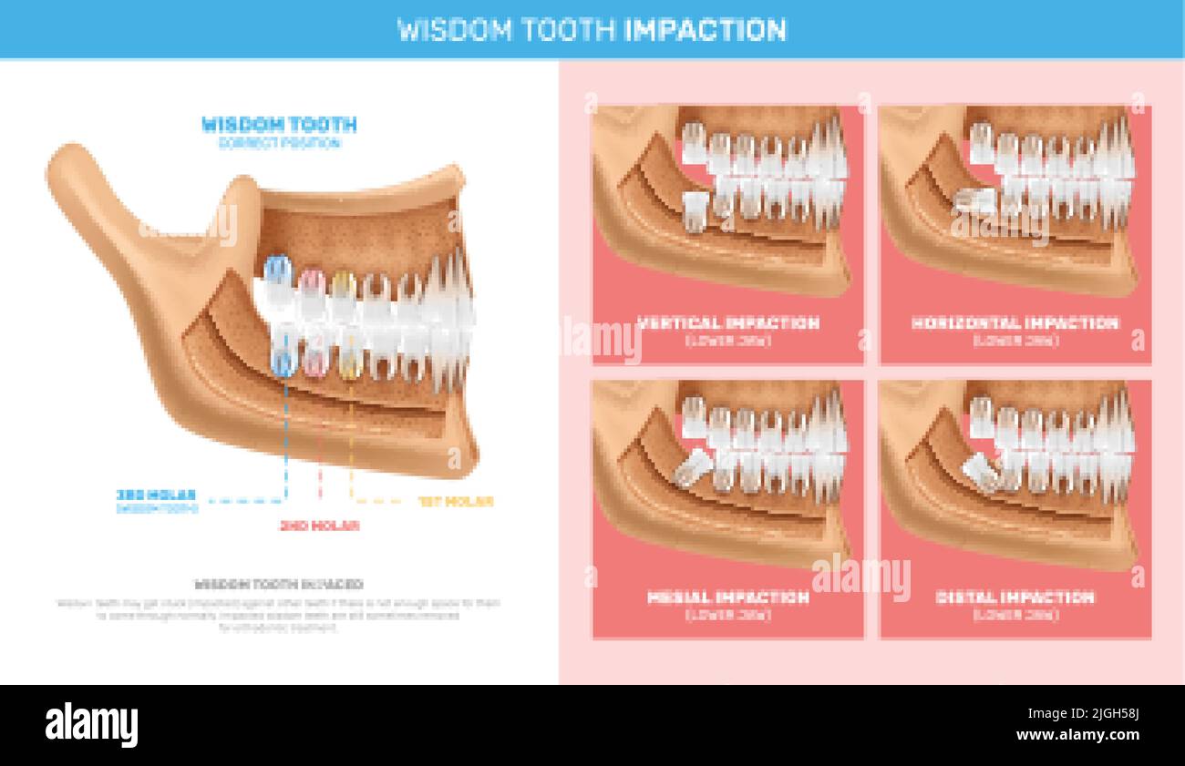 Wisdom tooth impaction infographics with anatomy chart and different options of problem realistic vector illustration Stock Vector