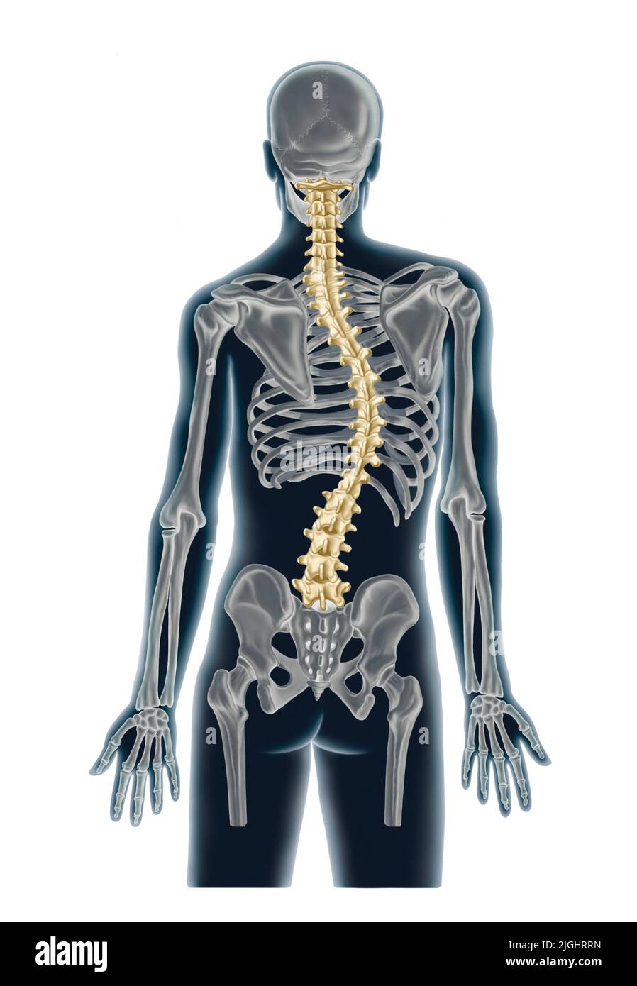 Scoliosis, abnormal lateral curving of the spine Stock Photo