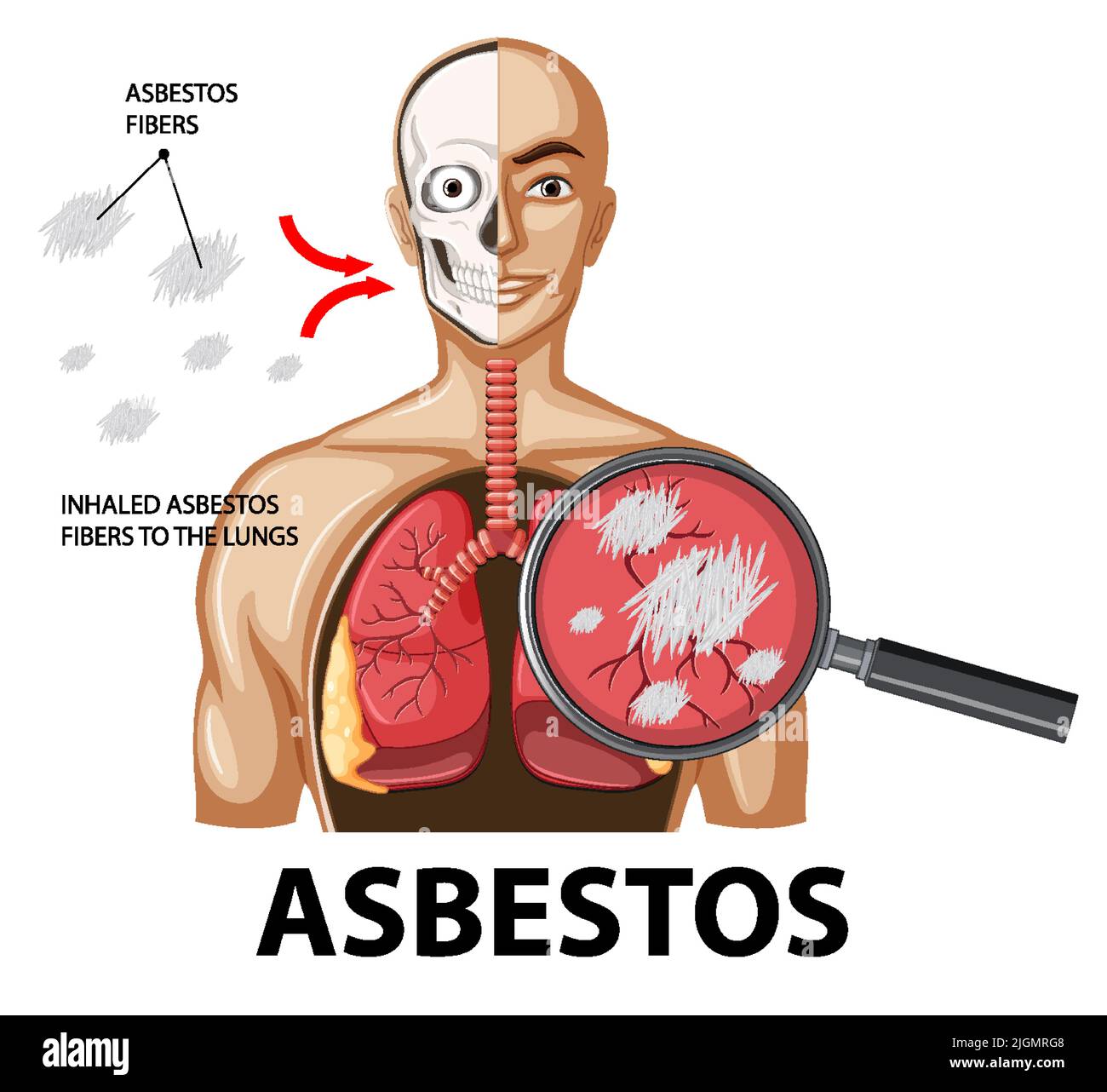 Diagram showing asbestosis in lungs illustration Stock Vector Image