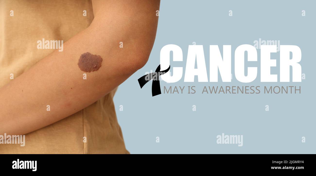 Young woman with birthmark, closeup. Skin cancer awareness month Stock ...