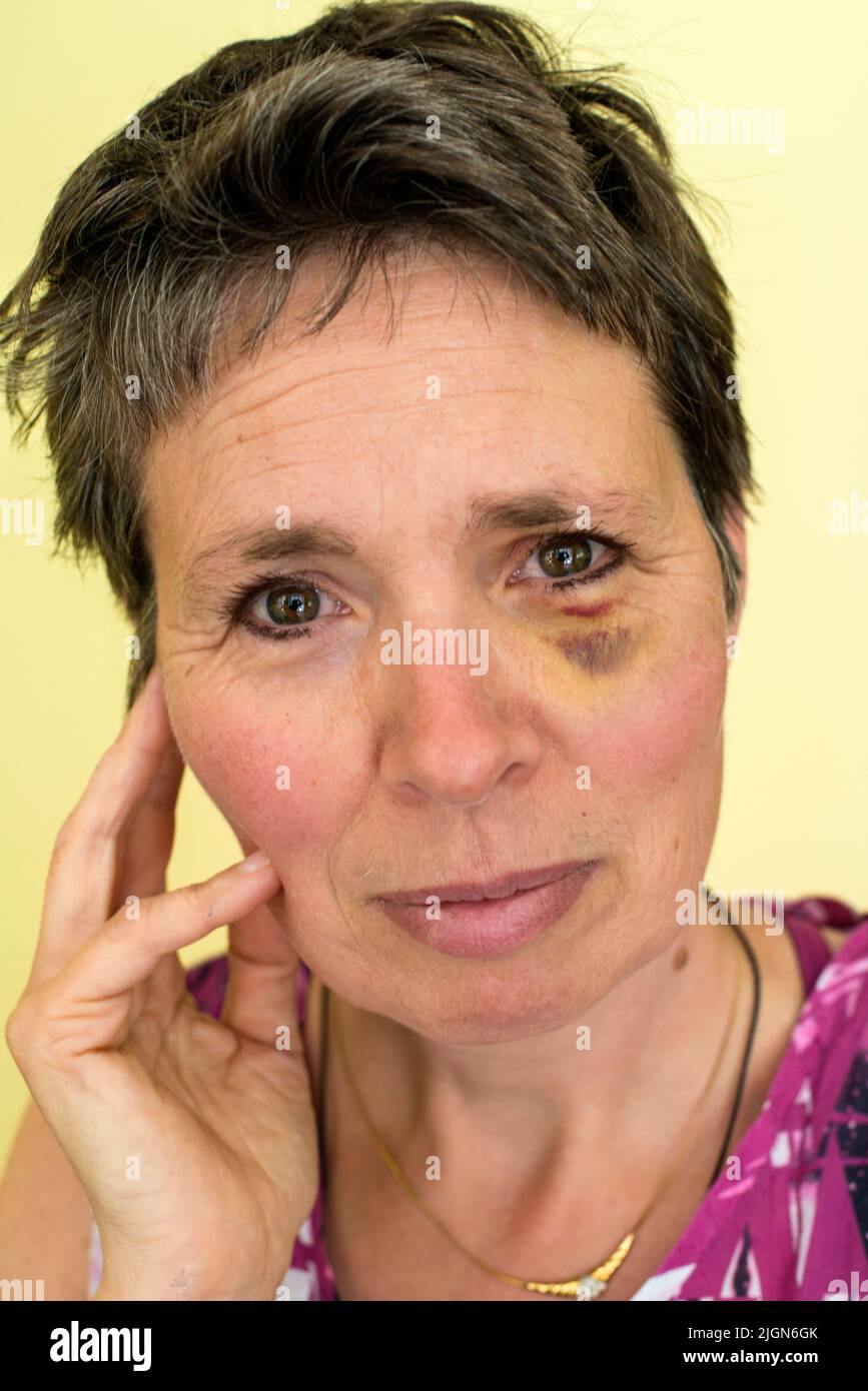 Tilburg, Netherlands. Mature adult woman, portrait, having a black eye after an accident on her bicycle. Stock Photo